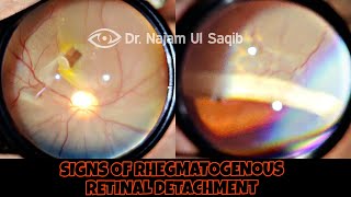 Clinical Signs Of Rhegmatogenous Retinal Detachment [upl. by Llerrej]