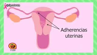 LEGRADO UTERINO y SINDROME DE ASHERMAN DRORIOL OLIVERA GINECÓLOGO DE AMECAE [upl. by Nyral]