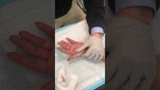 Cord rupture after Xiaflex injection for Dupuytrens Contracture [upl. by Enirak]