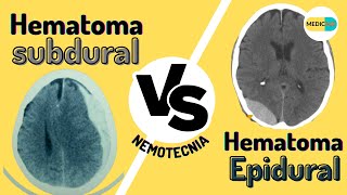 Diferencias entre HEMATOMA SUBDURAL Y EPIDURAL  NEMOTECNIA [upl. by Attelocin248]