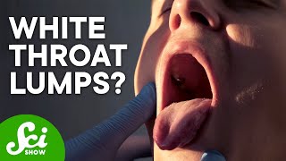 What Are Tonsil Stones amp How Do I Get Rid of Them [upl. by Mcclees131]