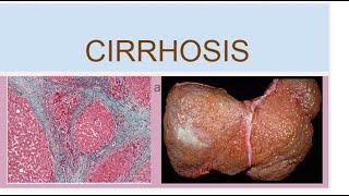 Cirrhosis [upl. by Aicilas]