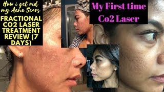 Acne Scars Removal First time Co2 laser treatment 7 Days Review [upl. by Amble451]