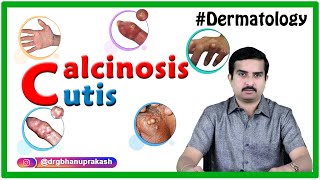 Calcinosis cutis  Dermatology clinicalessentials [upl. by Elocal]