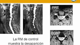 neurorgsnetherniadiscalcervicalabordajeconneuronavegador [upl. by Navarro]