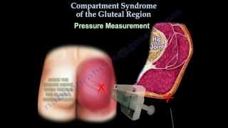 Compartment Syndrome Of The Gluteal Region  Everything You Need To Know  Dr Nabil Ebraheim [upl. by Vassaux801]