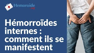 Hemoroide interne  tout comprendre sur les hemorroides internes [upl. by Sharpe]