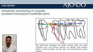 Orthodontic repositioning of a lingually positioned transmigrated mandibular canine [upl. by Obrien]