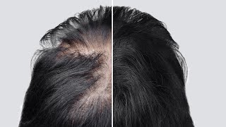 A revolutionary approach to combating hair loss  Peter Petrovich Garyaev  the science  Minoxidil [upl. by Aitnyc]