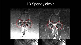 MRI of the Lumbar Spine  Part 9  Lumbar Trauma [upl. by Wildee148]