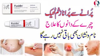 fucidin topical cream  fucidin cream  fucidin h cream uses in urdu  fucidin acid  how to use [upl. by Althee]