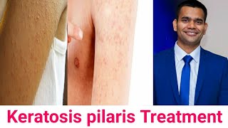 Keratosis Pilaris Cause Symptoms Ayurvedic Treatment [upl. by Oetsira280]