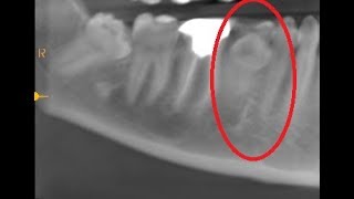 Retained deciduous molar amp Lingually placed premolar extraction [upl. by Yllier]