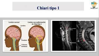 MALFORMACIONES CONGÃ‰NITAS DEL ENCEFALO Hidrocefalia Chiari Craneosinostosis Dandy Walker [upl. by Atiz828]