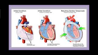 Cardiac Arrest Pulseless Electrical Activity [upl. by Neelyak157]