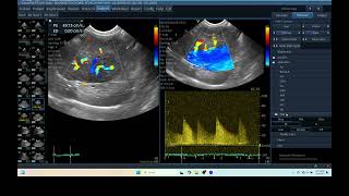 IQ 279 LIVER ULTRASOUND HEPATOMA ECHOPAC ANALYSIS ECHOCARDIOGRAPHY DOPPLER MODE [upl. by Nort15]