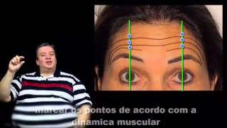 Botox para arquear a sobrancelha [upl. by Lerrehs]