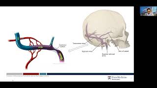 Etiology of Idiopathic Intracranial Hypertension IIH [upl. by Etteroma533]