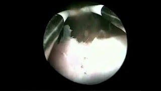 Hysteroscopic drainage of myometrial cystic adenomyosis [upl. by Eenafets322]