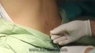 Epidural anesthesia [upl. by Relyc]