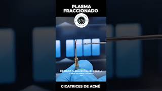 Plasmage para cicatrices de acné acnescars cicatrizdeacne cicatrizacion pielperfecta [upl. by Anihta]