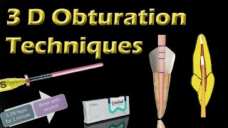 3 D Obturation of Root Canals  Materials equipment and techniques of obturation [upl. by Mani]