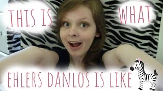 This Is What Ehlers Danlos Syndrome Is Like [upl. by Inerney27]