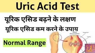 Uric Acid Test in Hindi  uric acid treatment  uric acid symptoms [upl. by Bernardo925]