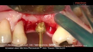 PIEZOSURGERY® Ultrasonic Implant Site Preparation UISP  technique [upl. by Honeyman]