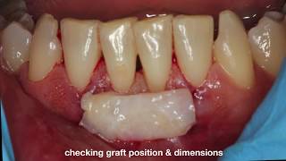 Connective Tissue Graft Tunneling Technique [upl. by Ttenneb]