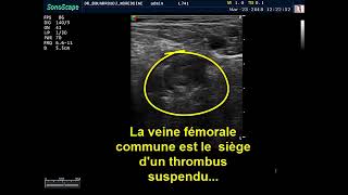 Découverte échographique dun thrombus suspendu au niveau de la veine fémorale commune [upl. by Signe154]