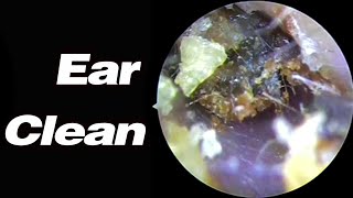 Ear Picking 8 Years Without Cleaning The Earwax Has Become Stones Very Hard To Remove耳掃除ASMR [upl. by Ynohta]