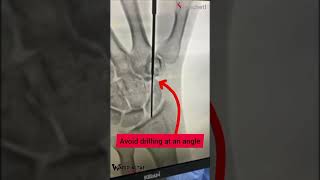 PERCUTANEOUS FIXATION OF SCAPHOID FRACTURE DR WARID ALTAF handsurgeon handsurgery scaphoid [upl. by Stefanac]