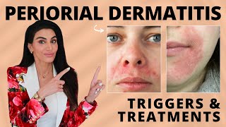 Perioral Dermatitis Triggers amp Treatment Recommendations by a Dermatologist [upl. by Darin435]