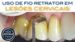 Uso de fio retrator em lesões cervicais de molares [upl. by Roanne653]