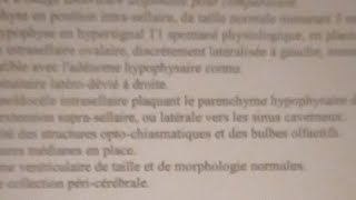 Hyperprolactinémie adénome hypophysaire Dostinex Parlodel  bilan médical et FAQ [upl. by Hgielrebmik]