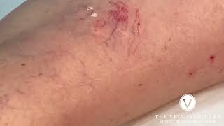 Sclerotherapy Procedure Spider Vein Treatment [upl. by Ark345]