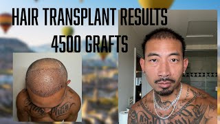 HAIR TRANSPLANT RESULTS 4500 Grafts [upl. by Agustin]