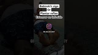 Babinski’s sign or Plantar reflex babinski’s sign plantarreflex neurology reflexes [upl. by Carolyne938]