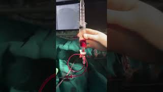 How Manual Thrombus Aspiration Catheter Works [upl. by Benny312]