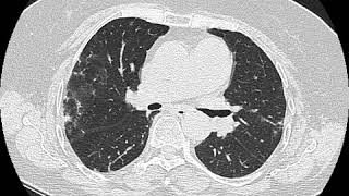 Amiodarone pulmonary fibrosis Ahuja AT et al 2017 Book Essential Radiology [upl. by Einama]