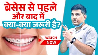 Watch this before getting Braces  Complete Braces care [upl. by Romonda218]