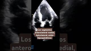 Hipoquinesia anterolateral medial y apical echocardiogram hipoquinesia akinesia infarto [upl. by Ileane]