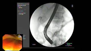 ERCP  Huge CBDCHD IHD stones for biliary stenting [upl. by Yral]