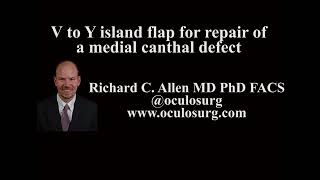 V to Y island flap for repair of a medial canthal defect [upl. by Zurkow787]