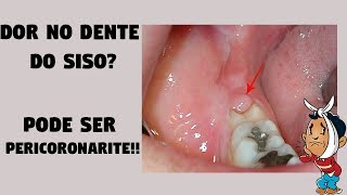 Pericoronarite e extração de dentes do siso © [upl. by Enniotna475]