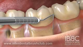 Periodontal disease causes and treatment [upl. by Melissa]