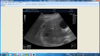 김일봉 알피니언 초음파 증례  Lthepatic hamangioma Multiple RtHepatic cysts Rtrenal cyst Ltperipelvic cyst [upl. by Ida619]