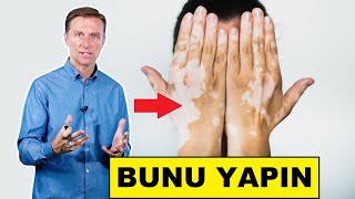 Vitiligo İçin Bu Üç Şeyi Yapmalısınız  DrBerg Türkçe [upl. by Kamilah246]