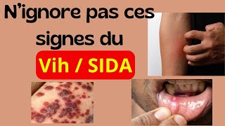 Quels sont les 13 signes du VIH  SIDA [upl. by Atipul]